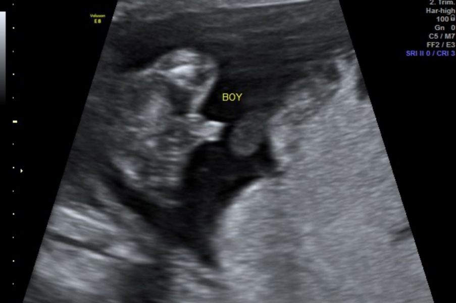 17wk gender scan query