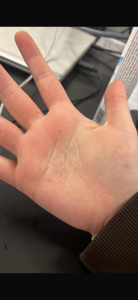 What is up with my daughters hands?