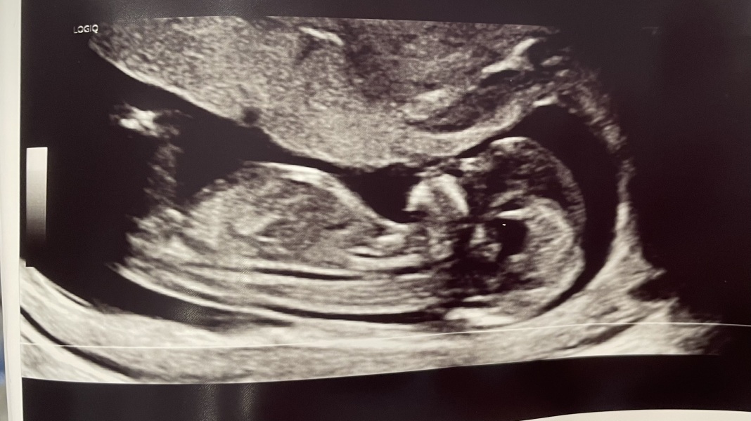 Nub theory pros, is this definitely a boy…?