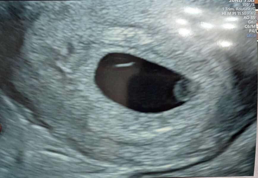 Early ultrasound experience- thought I was 6 weeks