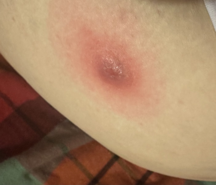 Huge ?boil on my hip