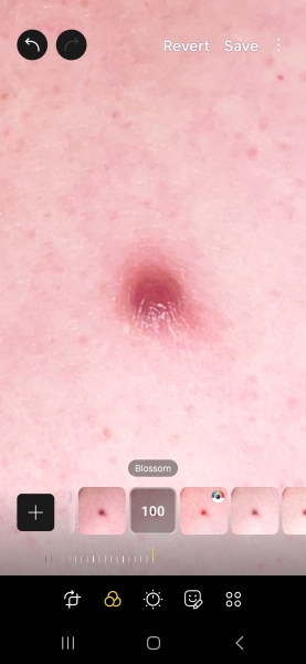 Mole on my back