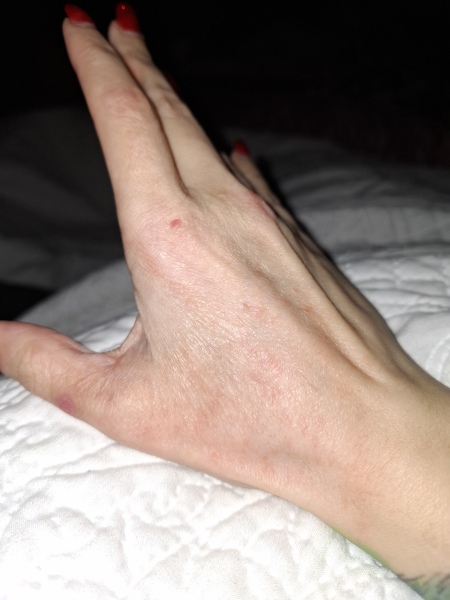 Hand infected (Warning, gross photos)