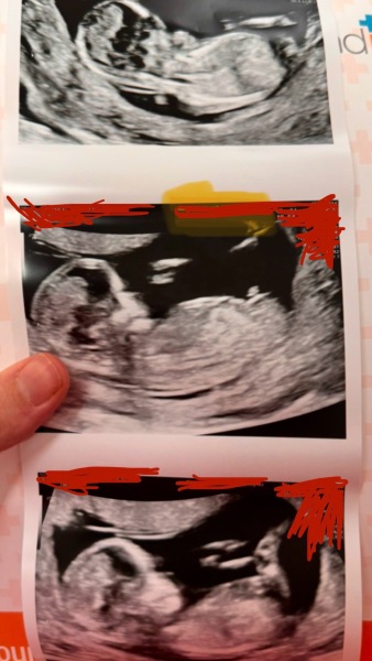 Nub theory pros, is this definitely a boy…?