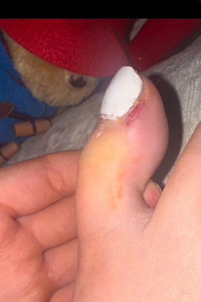 TMI WARNING - picture of infected toe