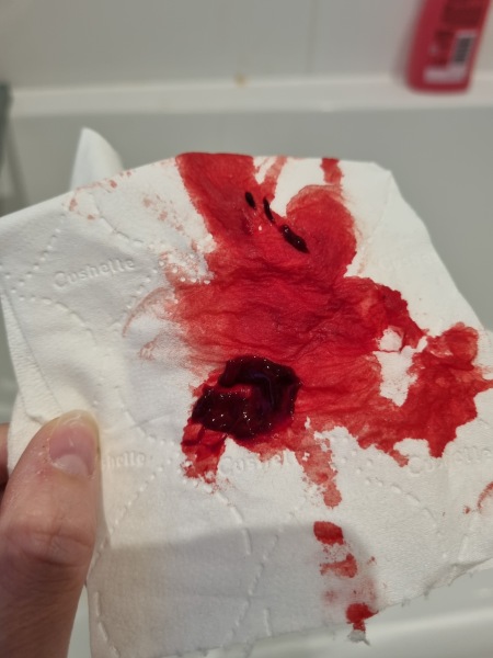 Is this a miscarriage? Trigger warning sensitive image