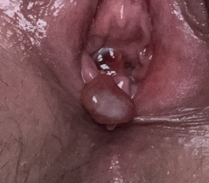 Granulation tissue and granuloma on episiotomy site