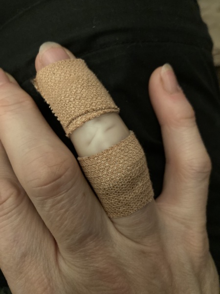 What am I supposed to do with this? Burnt finger; pic included