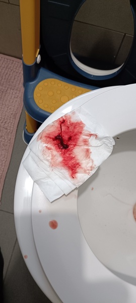 Large blood clot - PHOTO WARNING
