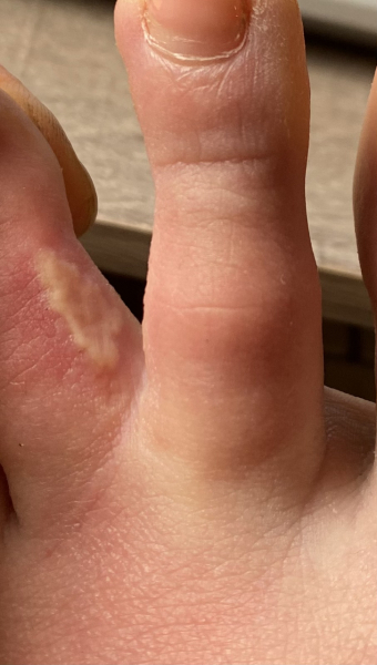 Is this Athletes Foot? Warning - pic