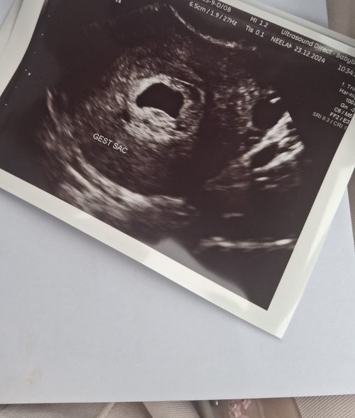 Need advice irregular gestational sac