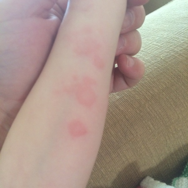 Caught ringworm from someone’s cat, should I post to Facebook