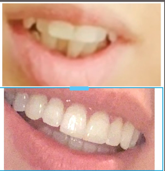 Invisalign cost yes or no