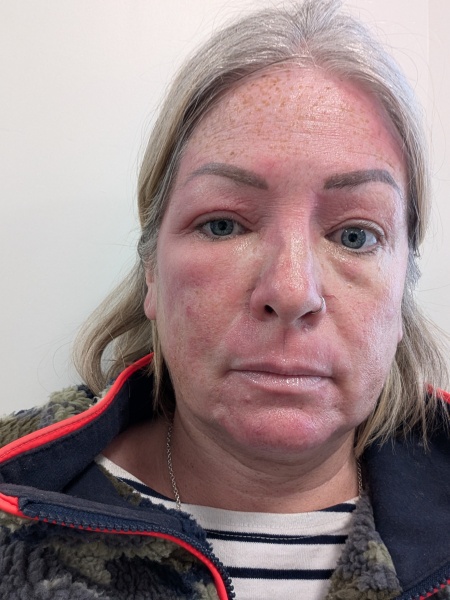 Possible cellulitis round eye, can't tell if it looks worse. Pics for opinions please!