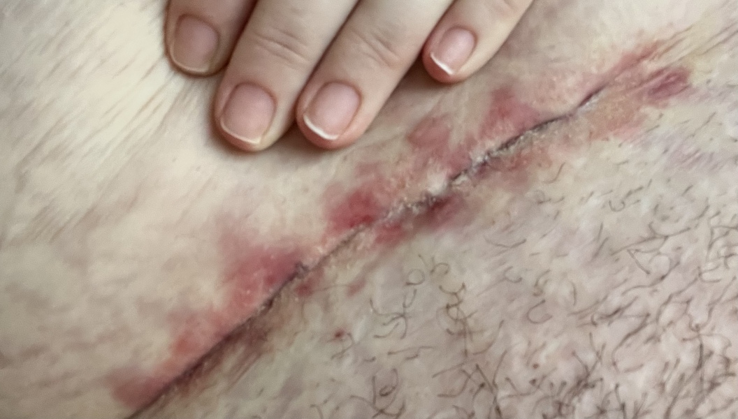 C-section scar looks awful 4 weeks PP [content warning added by MNHQ - graphic photo]