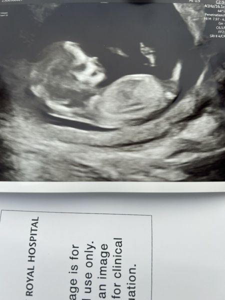 12 week scan gender predictions?