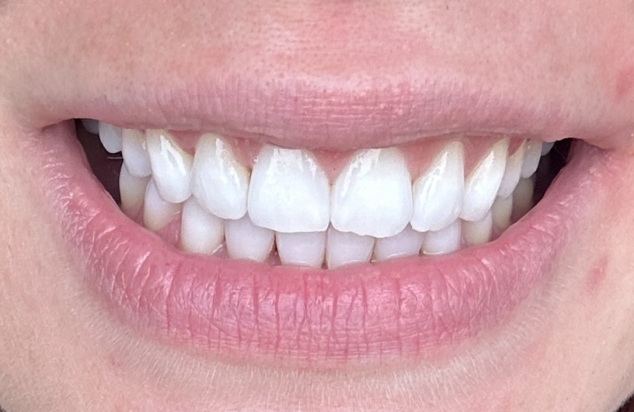 What cosmetic procedures have you had done?