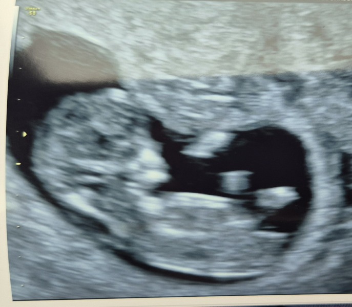 Worried about NT from private scan picture