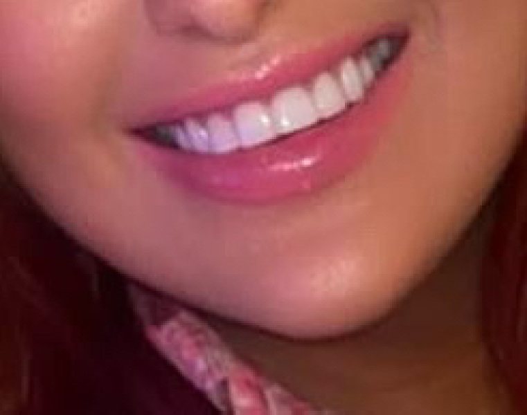 What cosmetic procedures have you had done?