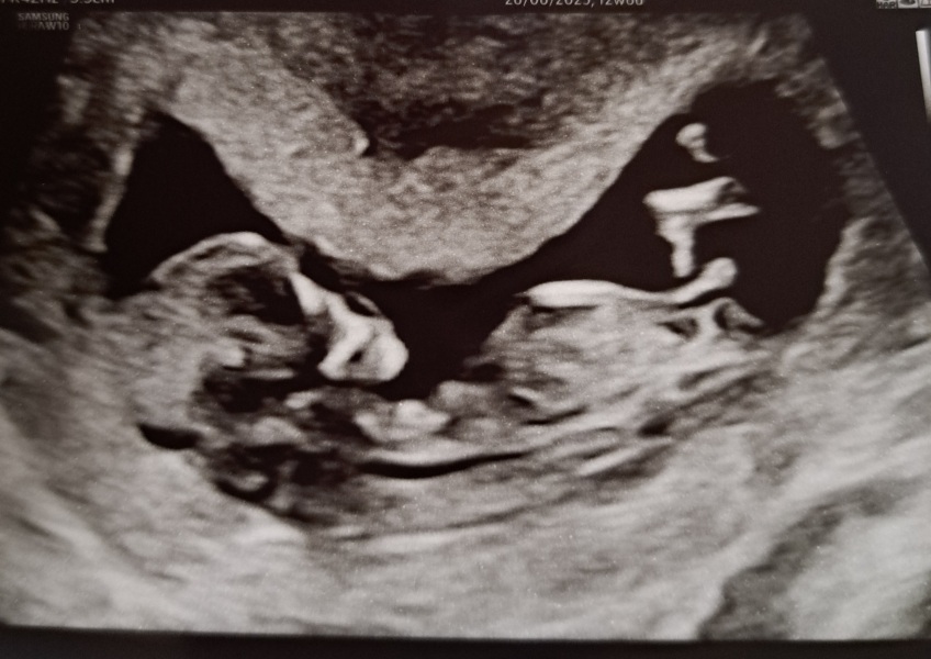 Due July 25 - Thread 2 - Approaching the 12 week scans!