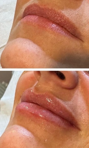 Why do people get massive amounts of lip filler?