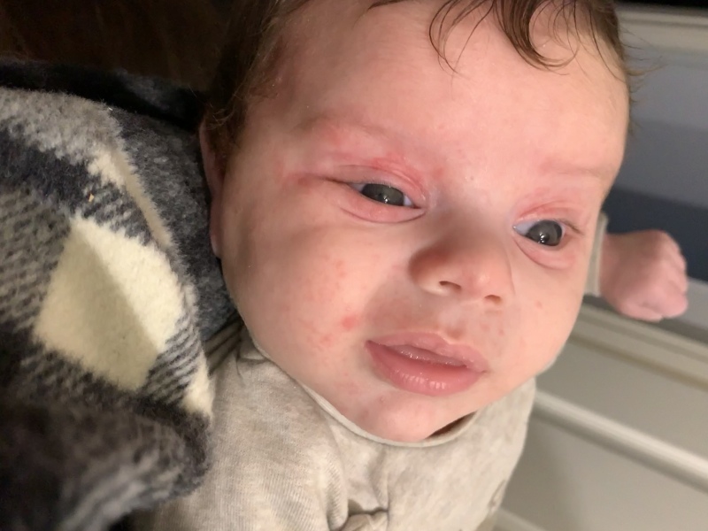 Baby acne/eczema or CMPA rash? Help pls.