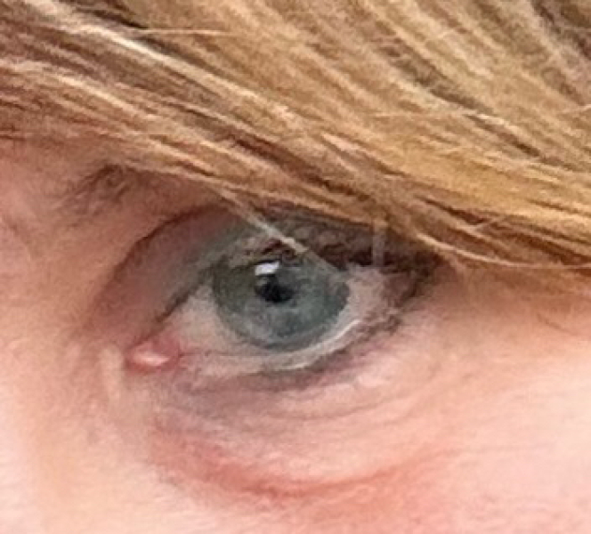 Red bags under both eyes