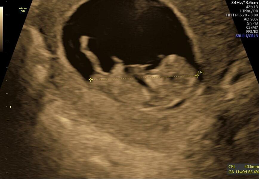 Due July 25 - Thread 2 - Approaching the 12 week scans!