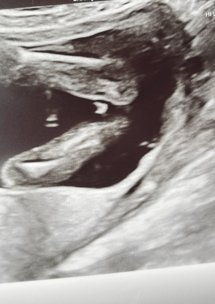 Potty shot 17 weeks