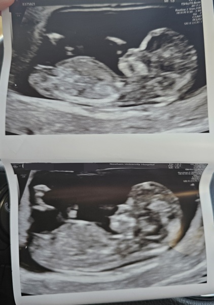 Boy or girl by nub and skull theory?!