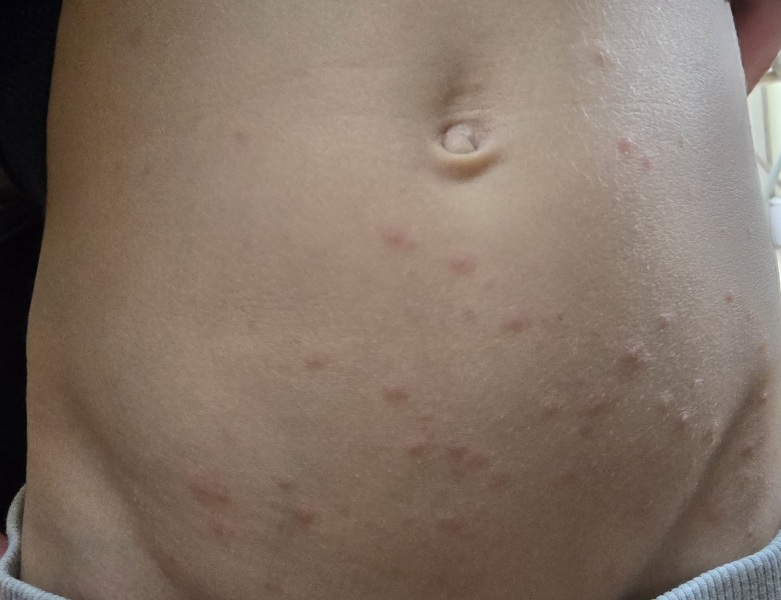 Is this chickenpox? Pic attached
