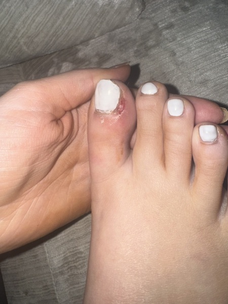 TMI WARNING - picture of infected toe