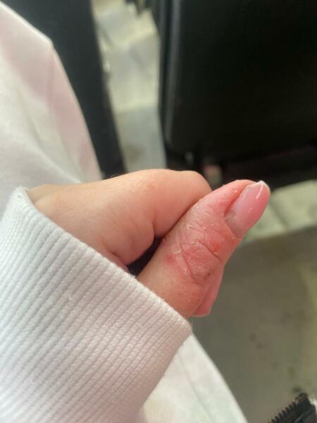 Is this Excema or something else, with photos.