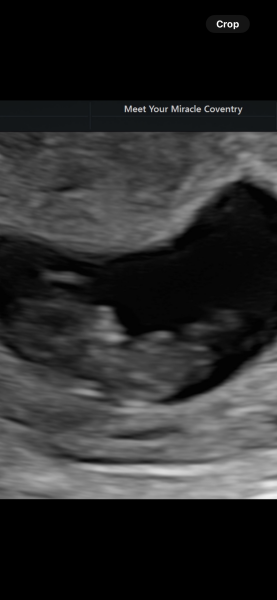 11DPO positive - but concerned