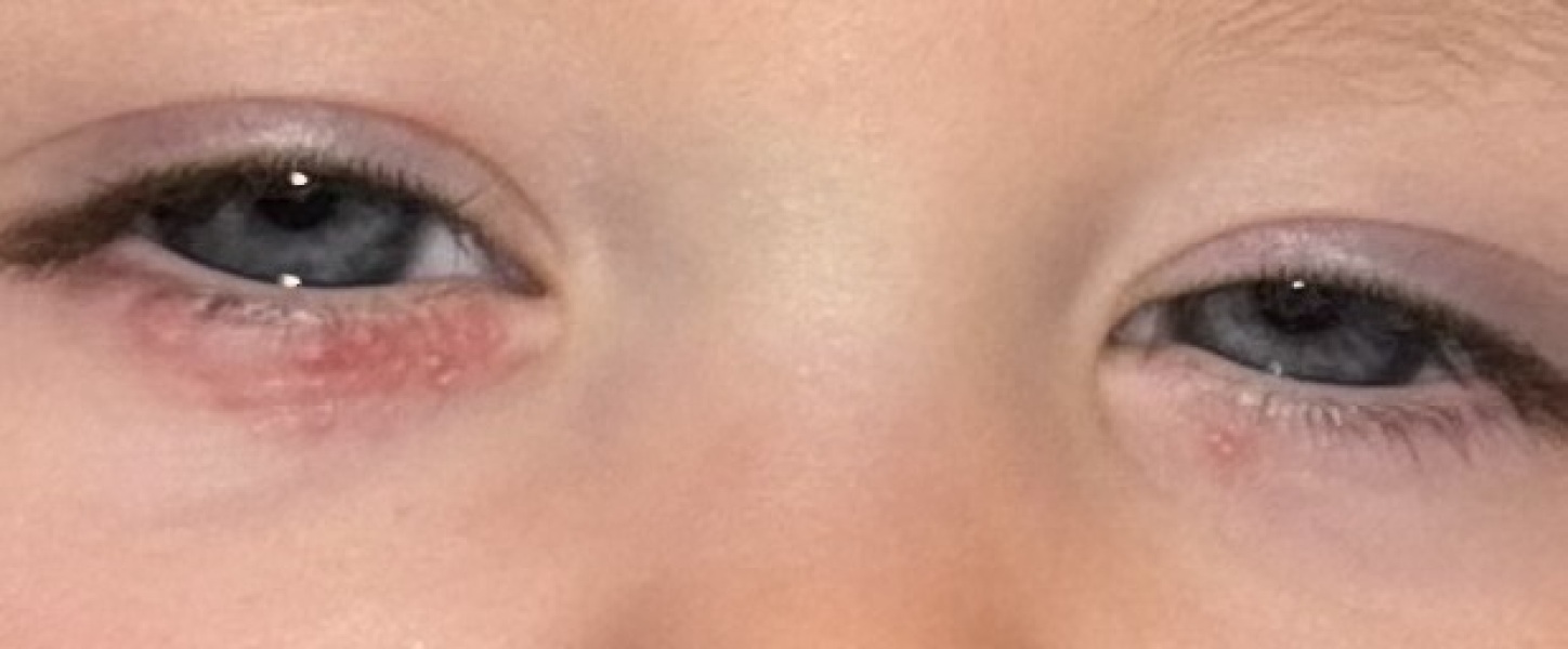 Does this look like eczema?