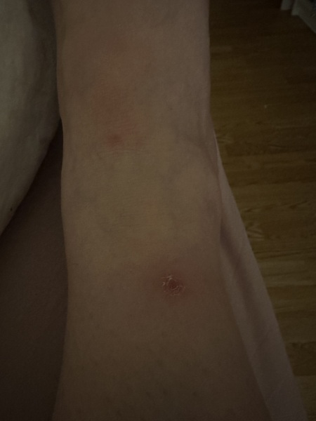 (Warning pic attached)Are they flea or bed bug bites ?
