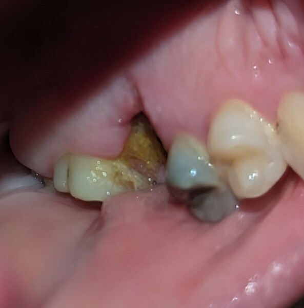 Is this normal after tooth extraction?