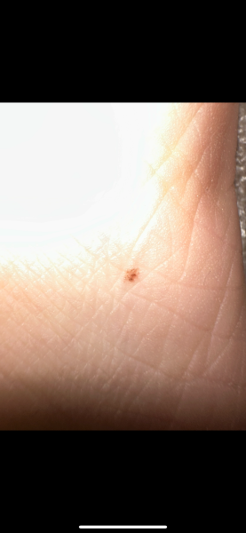 Mole on side of foot