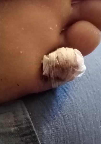 Melanoma on little toe? Picture attached.