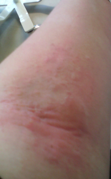 Best place for allergy testing in the North West