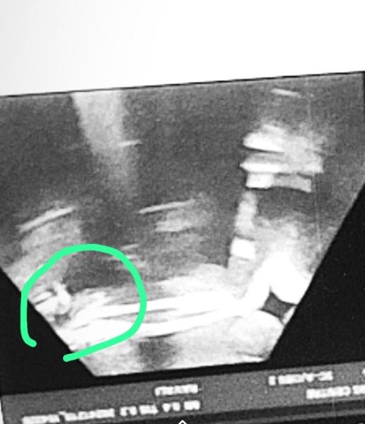 34 weeks baby ultrasound scan image can you guess the baby part is pennis or umbilical cord?