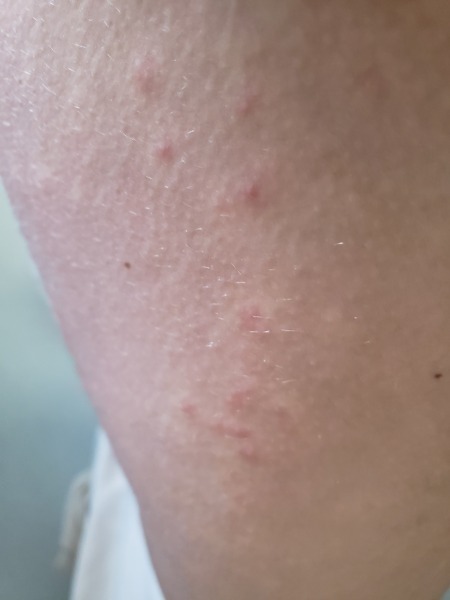 Christmas rash