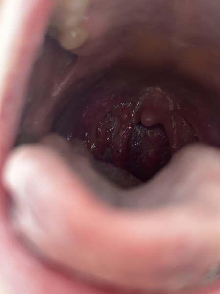 Red bump in back of throat
