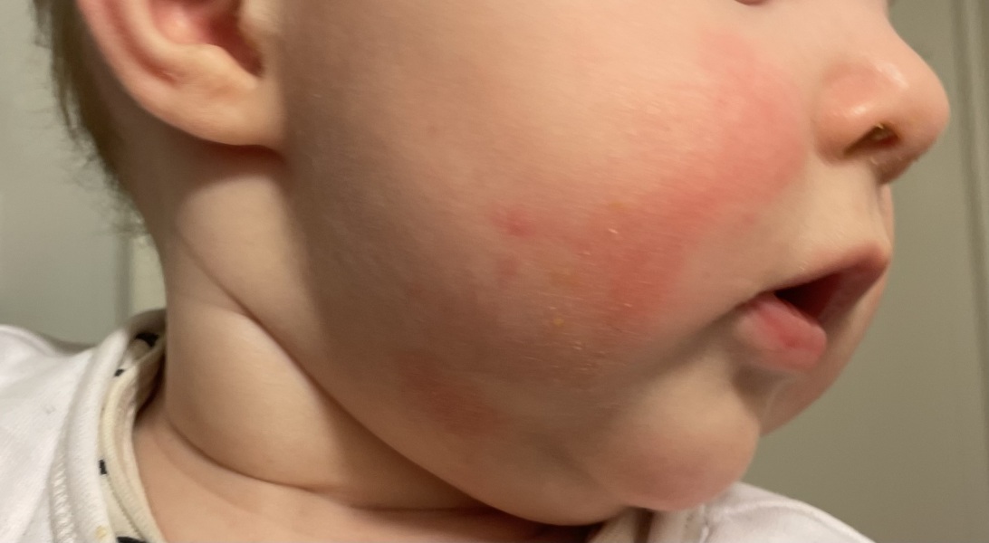 Allergy or teething?