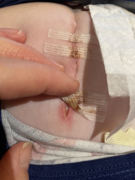Wound healing - stitches haven’t closed