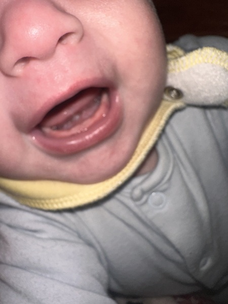 Baby teething at 3.5 months