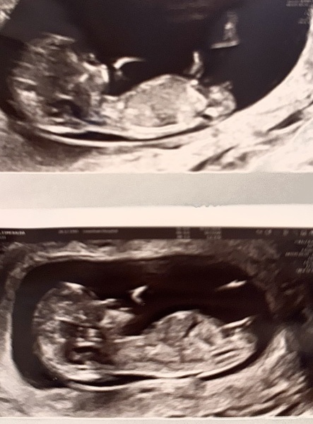 Due July 25 - Thread 2 - Approaching the 12 week scans!
