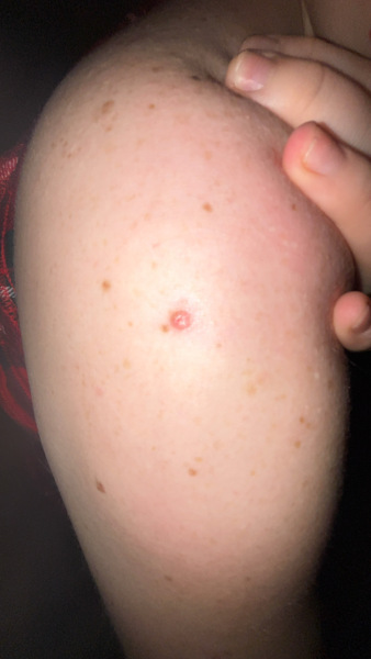 Mole or Spot?