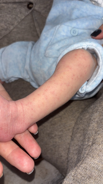 3 week old rash