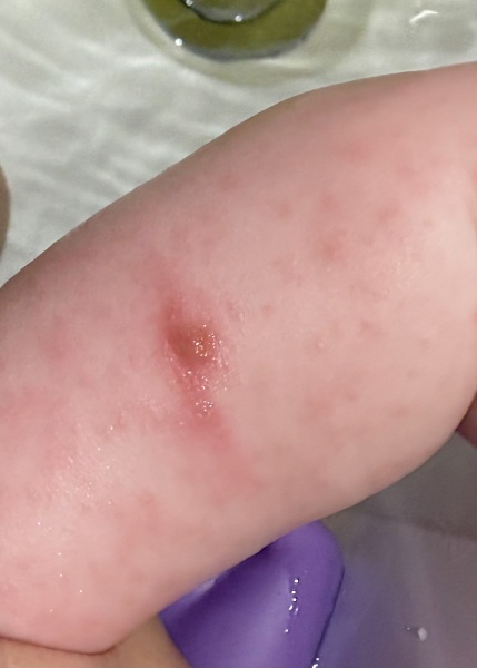 Does this look infected? Chicken pox